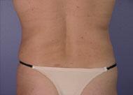 Liposuction Before & After Image