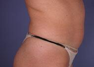 Liposuction Before & After Image