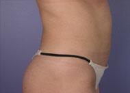 Liposuction Before & After Image