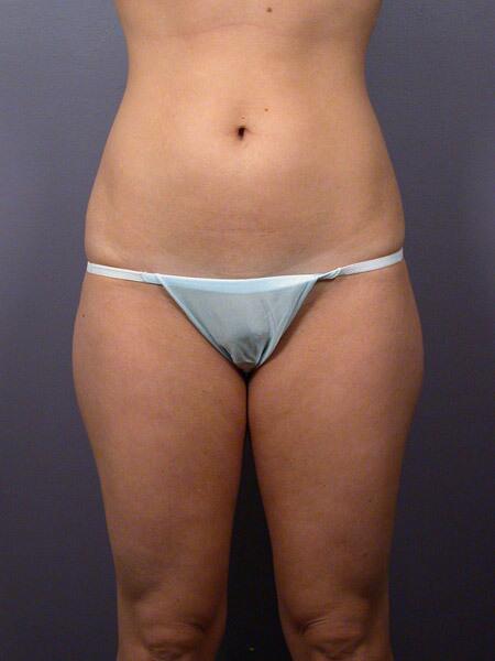 Liposuction Before & After Image