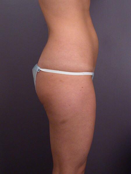 Liposuction Before & After Image