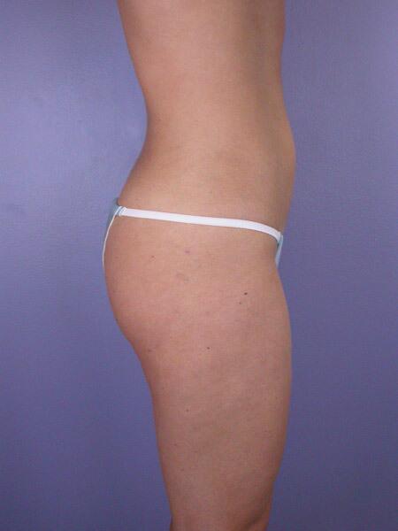 Liposuction Before & After Image