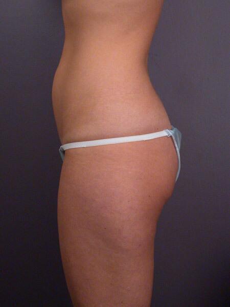 Liposuction Before & After Image