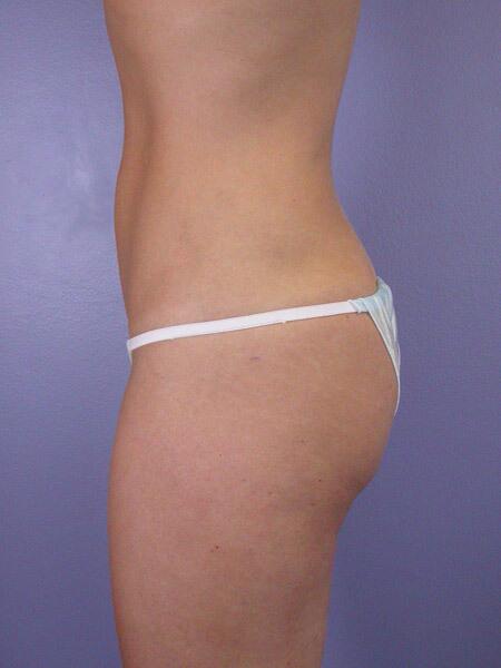 Liposuction Before & After Image