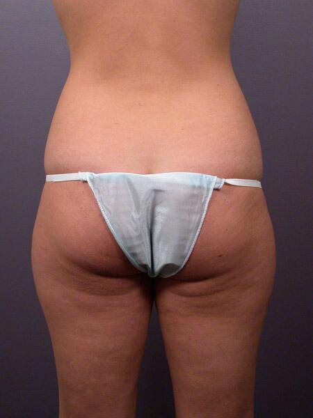 Liposuction Before & After Image