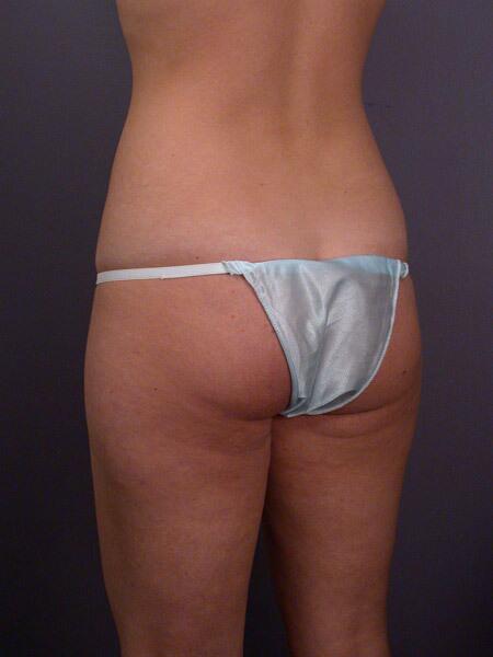 Liposuction Before & After Image