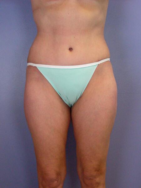 Liposuction Before & After Image