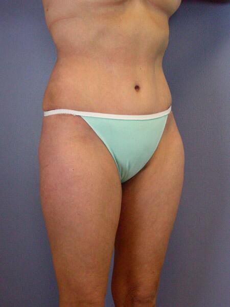 Liposuction Before & After Image