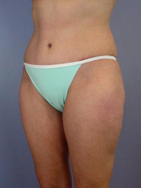 Liposuction Before & After Image