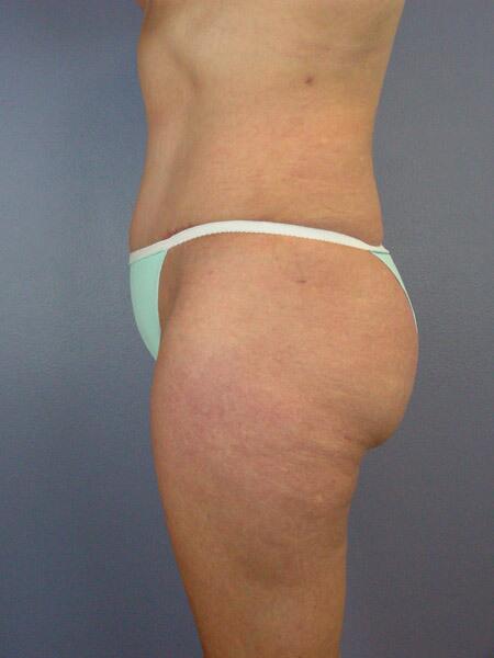 Liposuction Before & After Image