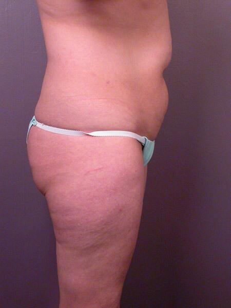 Liposuction Before & After Image