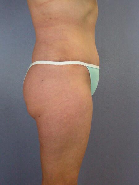 Liposuction Before & After Image