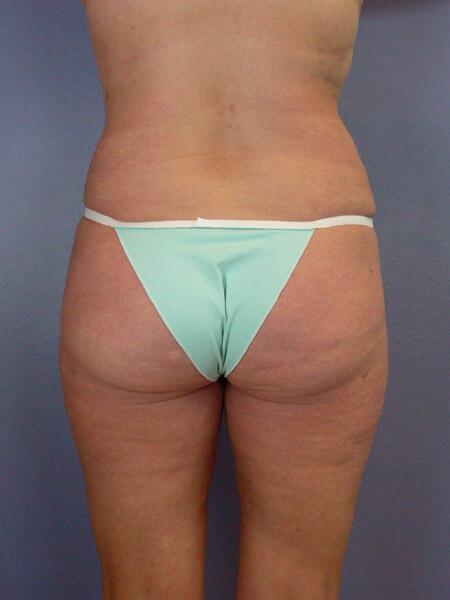 Liposuction Before & After Image