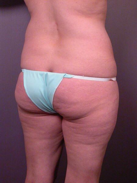 Liposuction Before & After Image