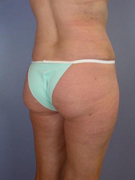 Liposuction Before & After Image