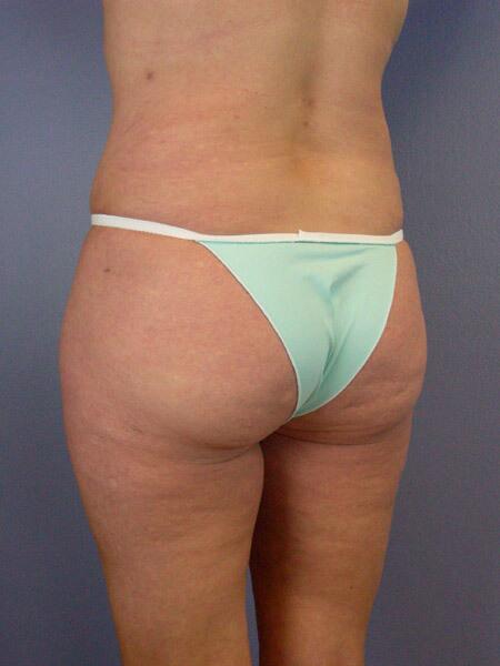 Liposuction Before & After Image