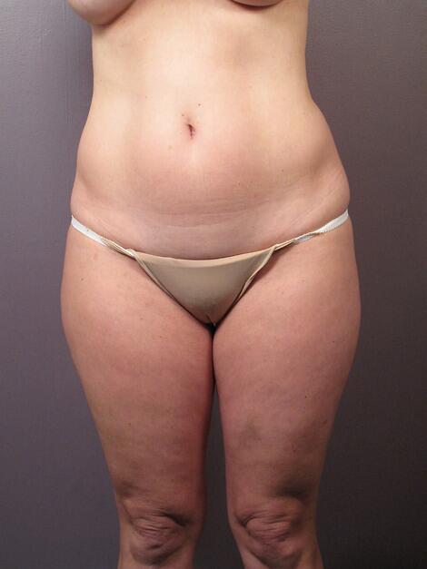 Liposuction Before & After Image