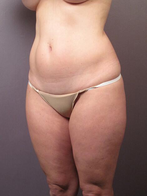 Liposuction Before & After Image