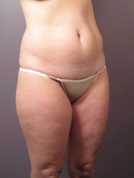 Liposuction Before & After Image