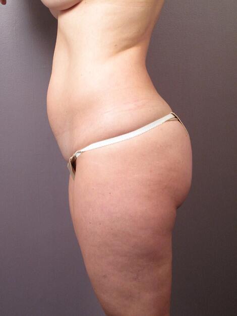 Liposuction Before & After Image