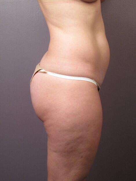 Liposuction Before & After Image