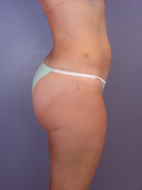 Liposuction Before & After Image