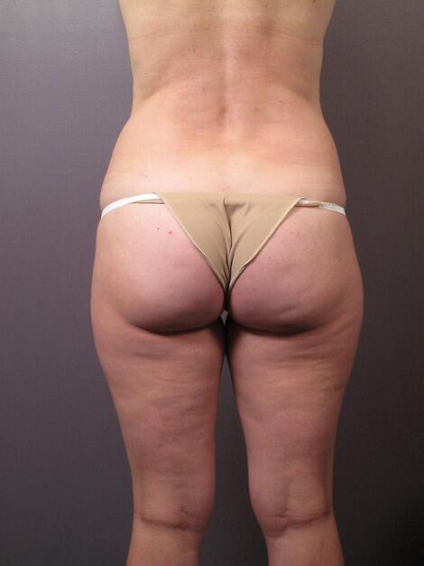 Liposuction Before & After Image