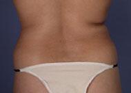 Liposuction Before & After Image