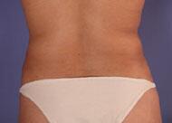 Liposuction Before & After Image