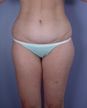 Liposuction Before & After Image