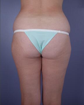 Liposuction Before & After Image