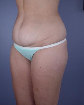 Liposuction Before & After Image