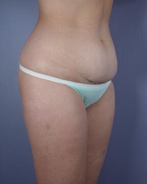 Liposuction Before & After Image