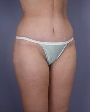 Liposuction Before & After Image