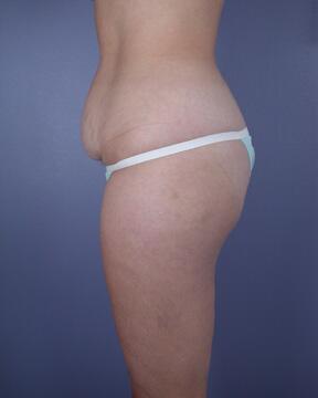 Liposuction Before & After Image