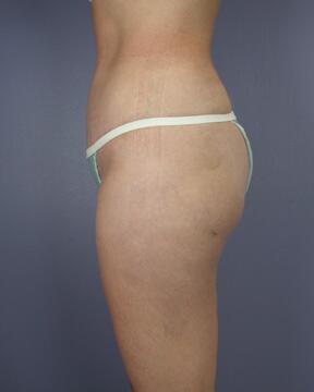 Liposuction Before & After Image