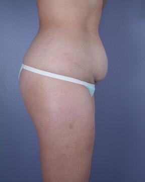 Liposuction Before & After Image