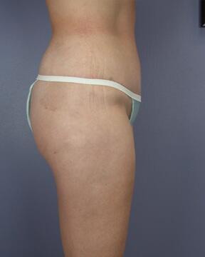 Liposuction Before & After Image