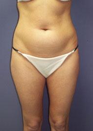 Liposuction Before & After Image