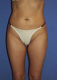 Liposuction Before & After Image