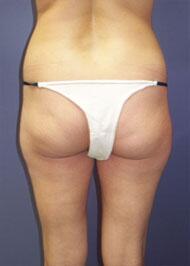 Liposuction Before & After Image