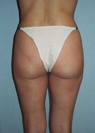 Liposuction Before & After Image