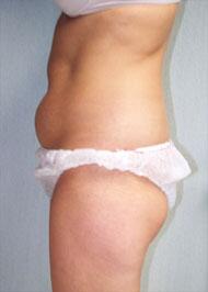 Liposuction Before & After Image