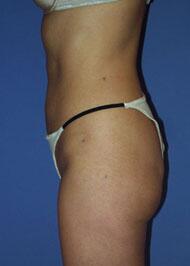 Liposuction Before & After Image