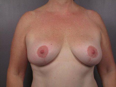 Liposuction Before & After Image