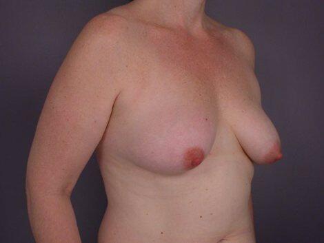 Liposuction Before & After Image