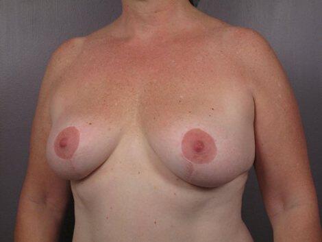 Liposuction Before & After Image