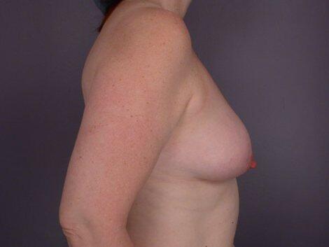 Liposuction Before & After Image