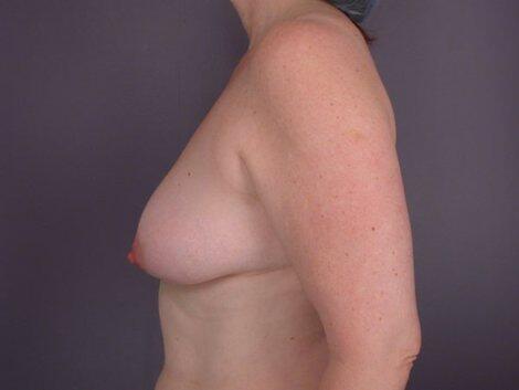 Liposuction Before & After Image