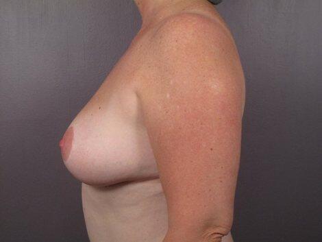 Liposuction Before & After Image